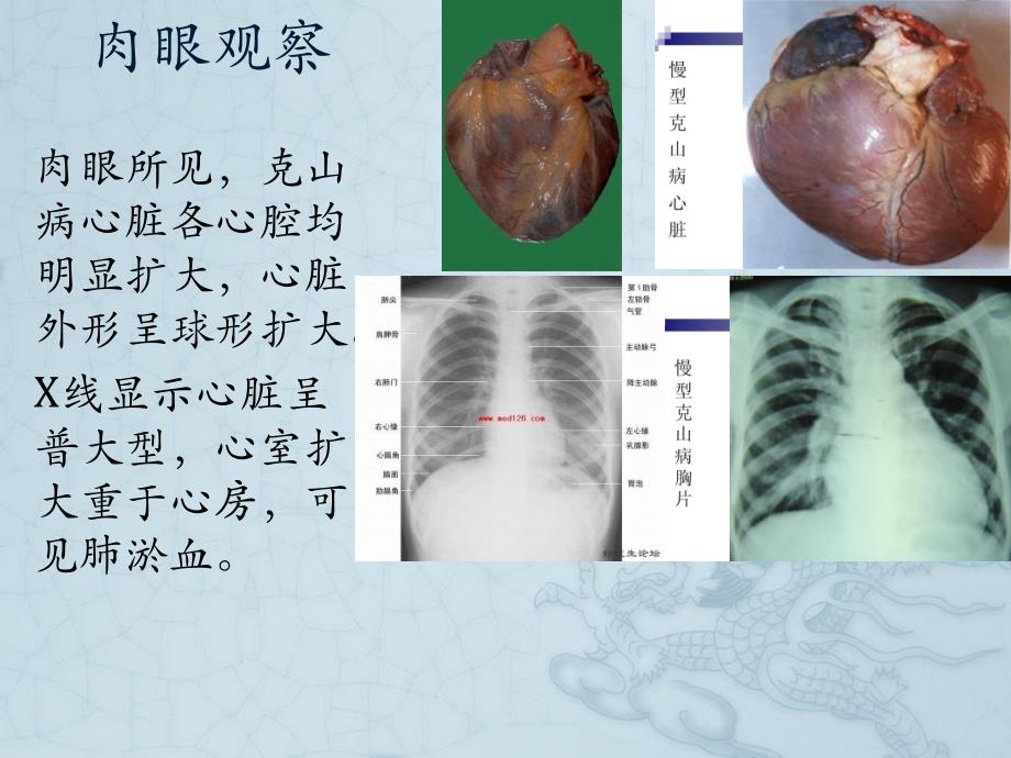 克山病病理及临床诊断和鉴别诊断ppt课件_第4页