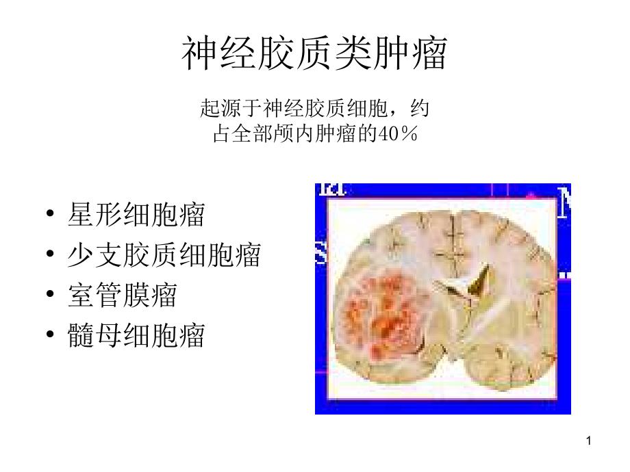 星形细胞瘤CT诊断-文档资料_第1页