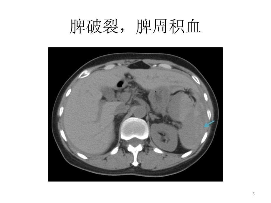 腹部实质性脏器外伤的CT表现-文档资料_第5页