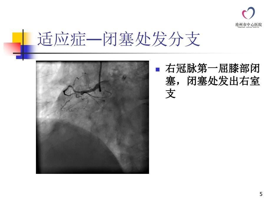 逆向导丝技术在CTO介入治疗中的操作技巧-文档资料_第5页