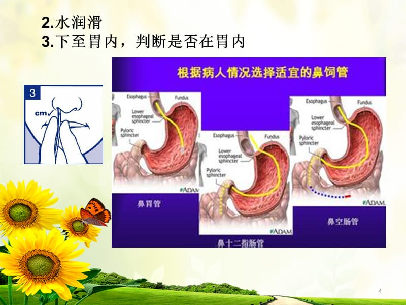 空肠营养管的置入-文档资料_第4页