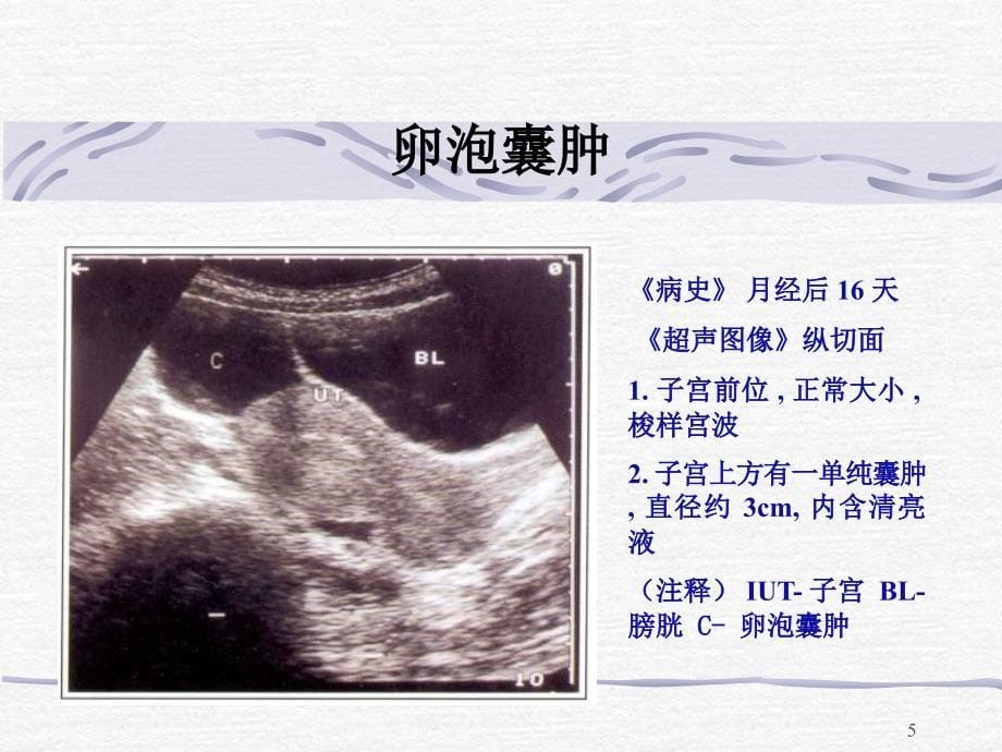 卵巢肿瘤的超声诊断nx-文档资料_第5页