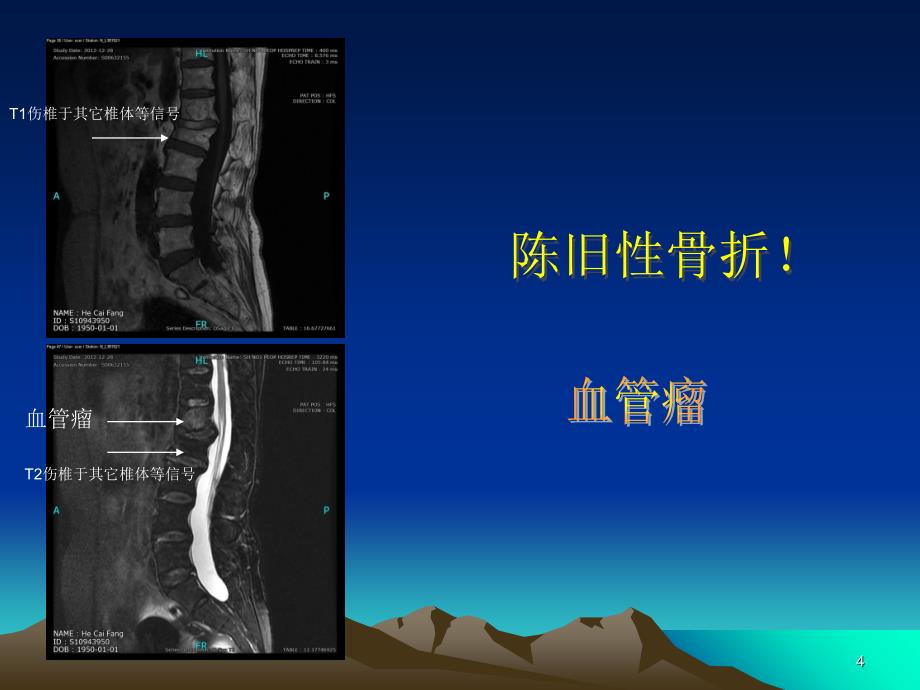 脊柱典型病例-文档资料_第4页