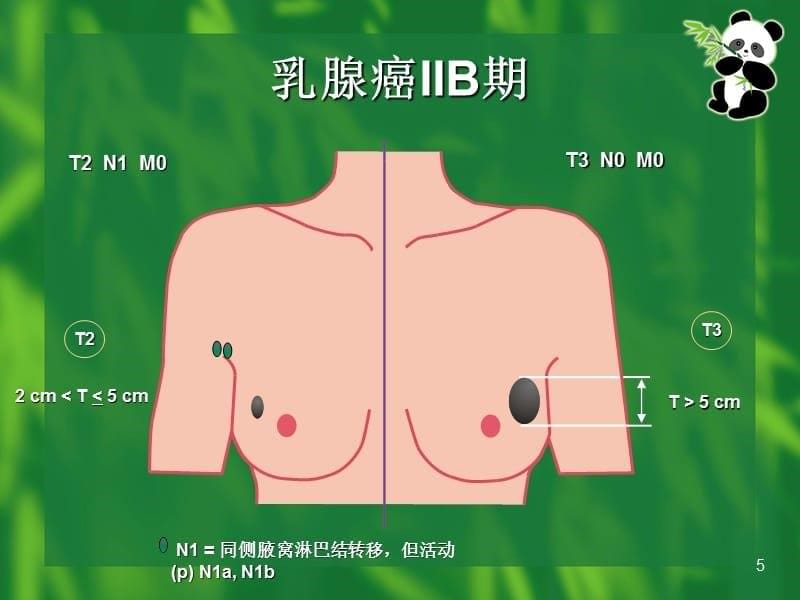 乳腺癌TNM 分期-文档资料_第5页