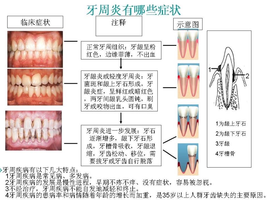 牙周炎的分类及临床表现 ._第2页