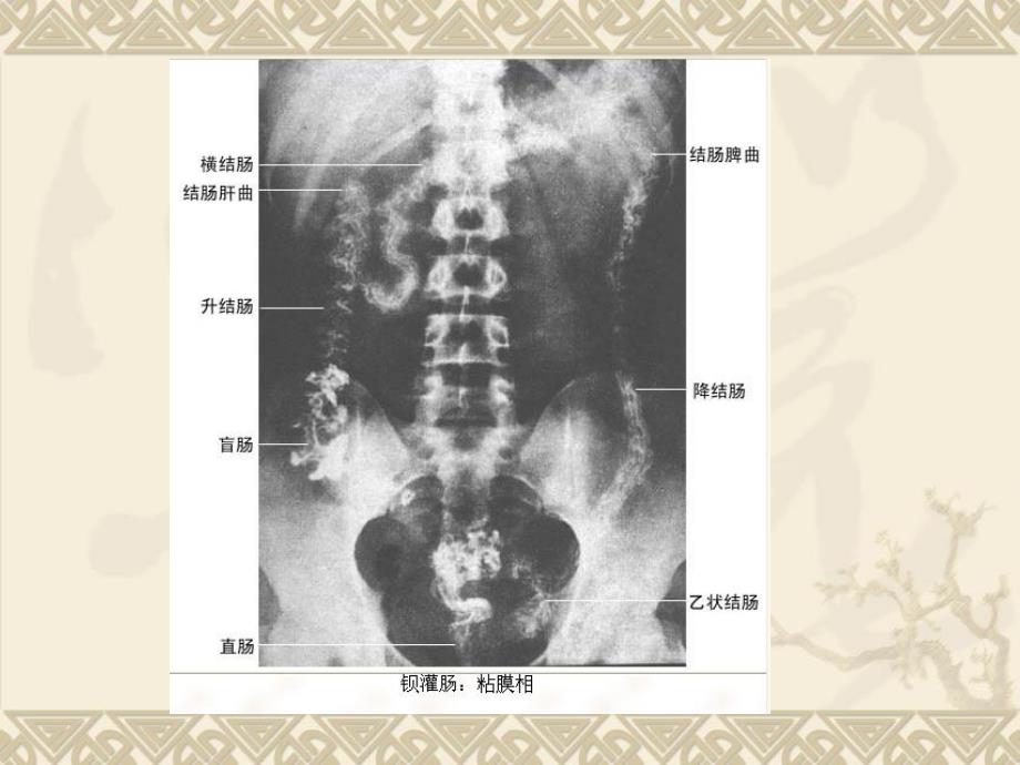 医学影像学第七版肠道系统课件_第4页