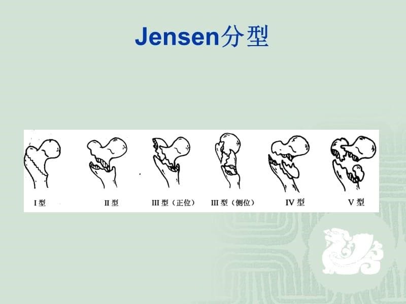 股骨粗隆间骨折 分类PPT_第5页