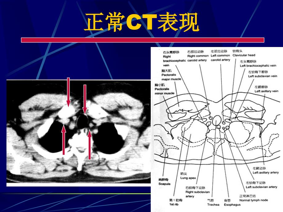 肺部正常CT课件PPT_第1页