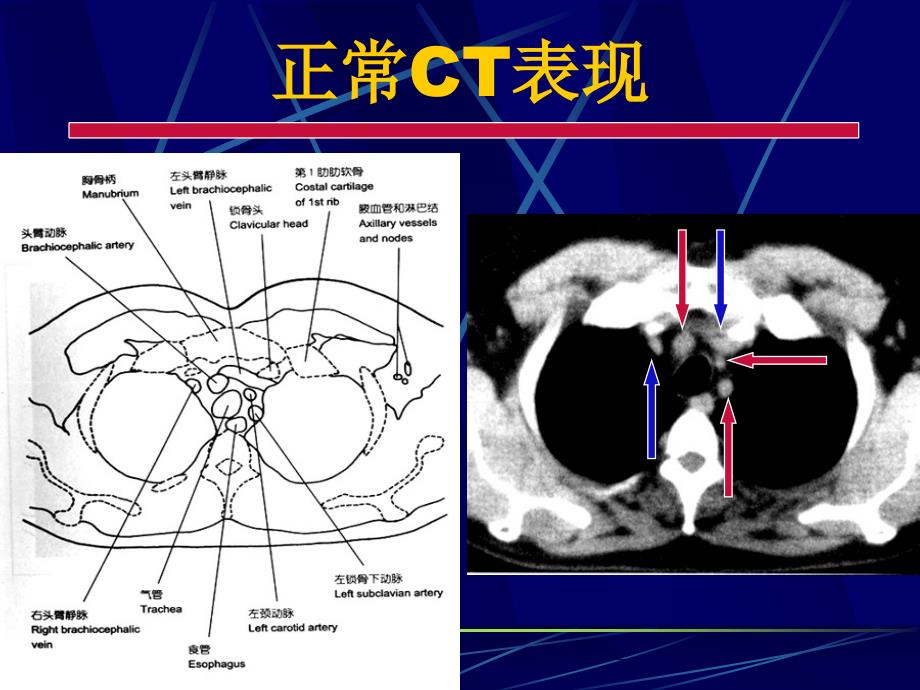 肺部正常CT课件PPT_第3页