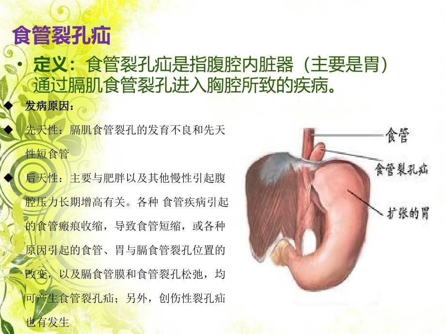 膈疝护理查房PPT_第5页