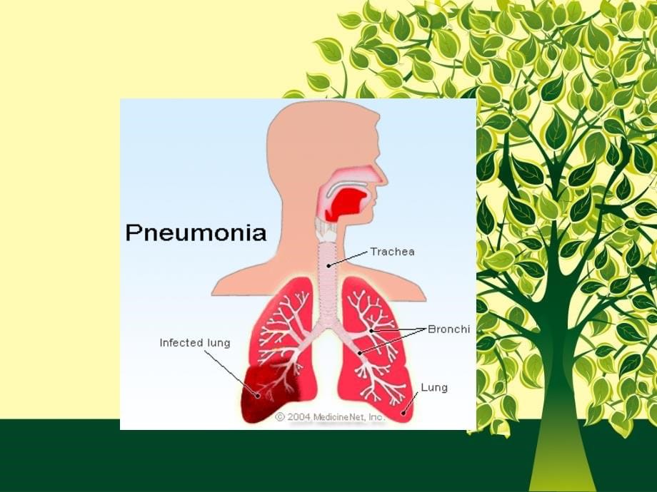 肺炎的护理(PPT带案例)_第5页