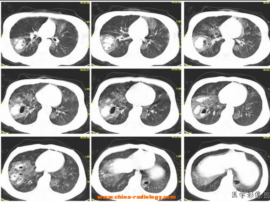 肺挫伤的病理及影像表现PPT_第4页