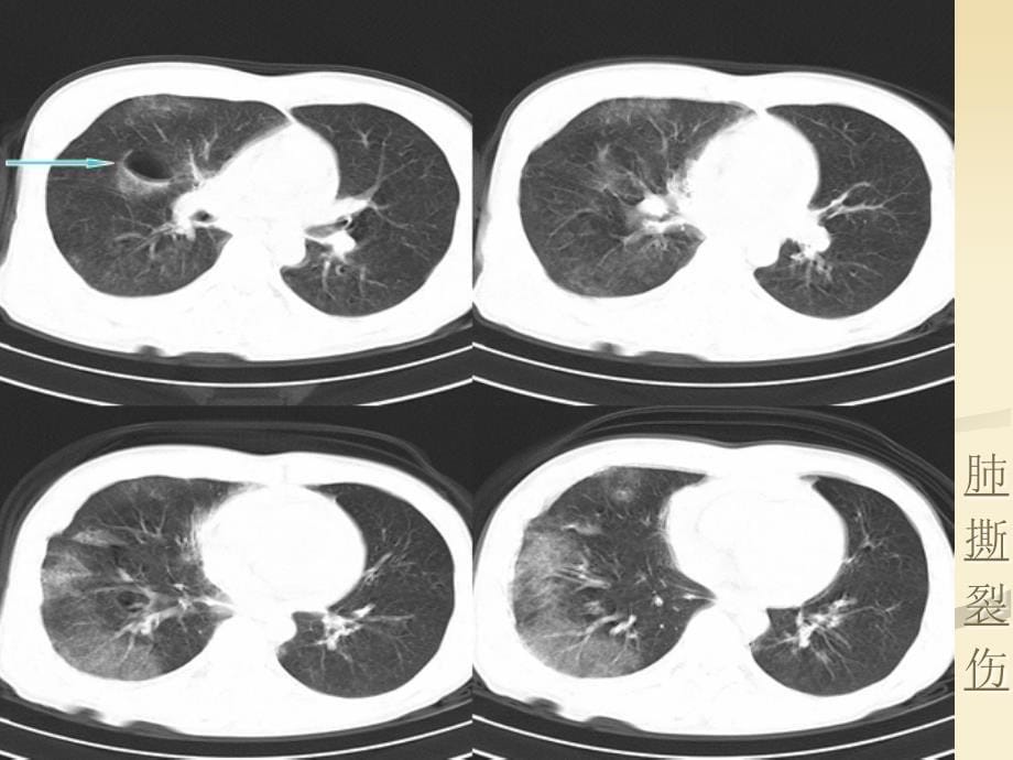 肺挫伤的病理及影像表现PPT_第5页