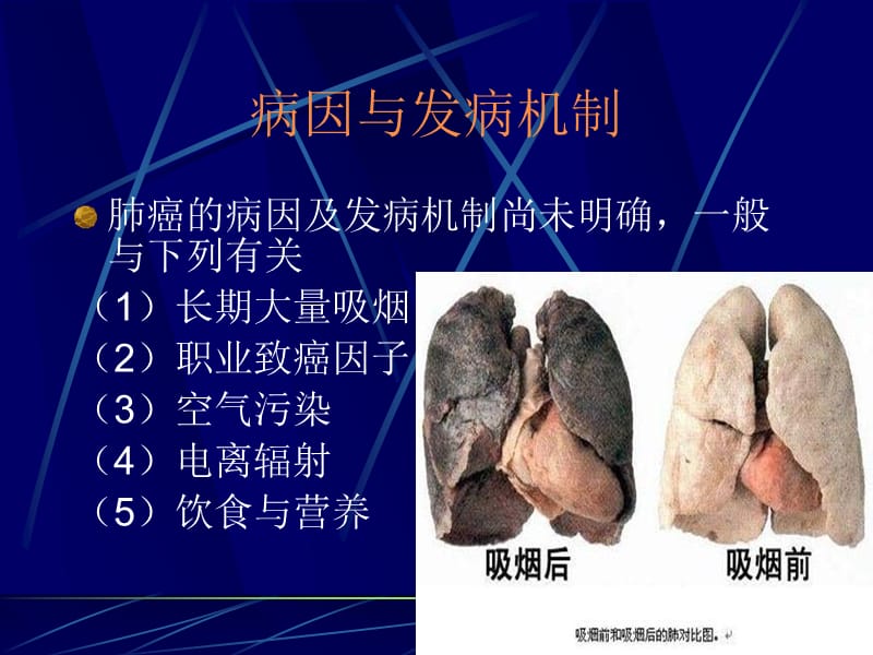 肺癌的护理查房PPT16_第5页