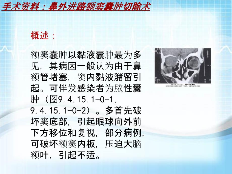 外科手术教学资料：鼻外进路额窦囊肿切除术讲解模板_第4页