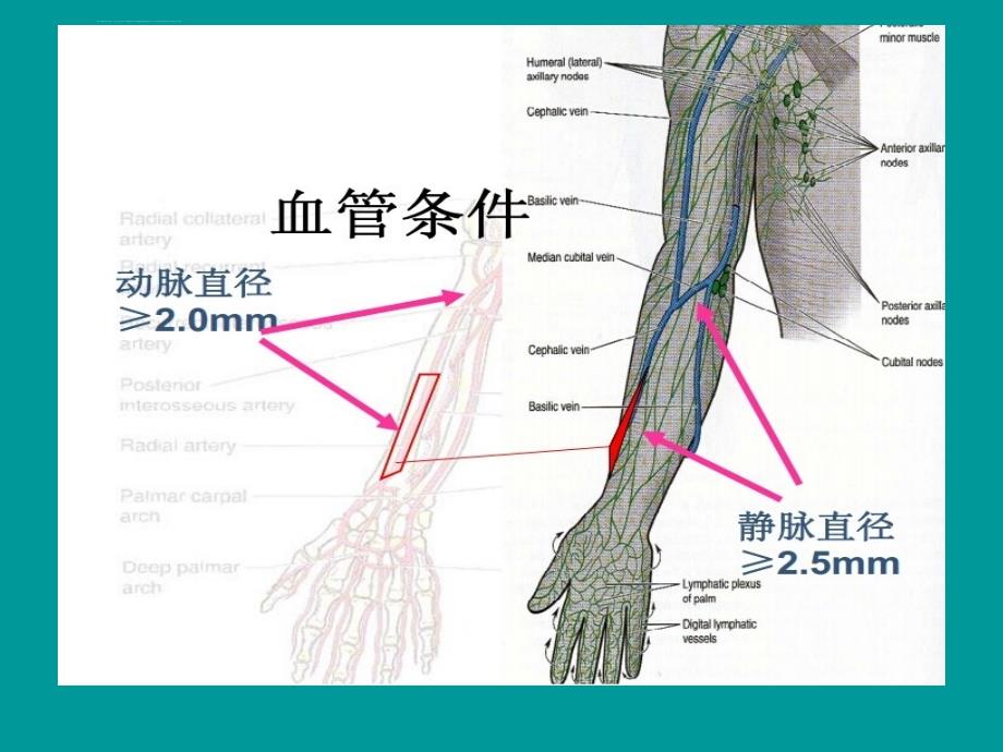 血透通路内瘘相关课件_第4页