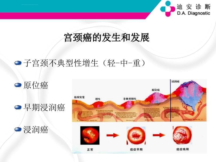 TCT和HPV检测在宫颈癌诊断中的临床应用课件_第5页