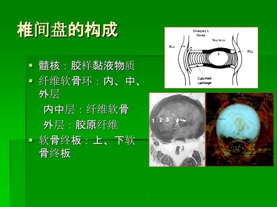 椎间盘突出的影像学诊断ppt课件_第5页