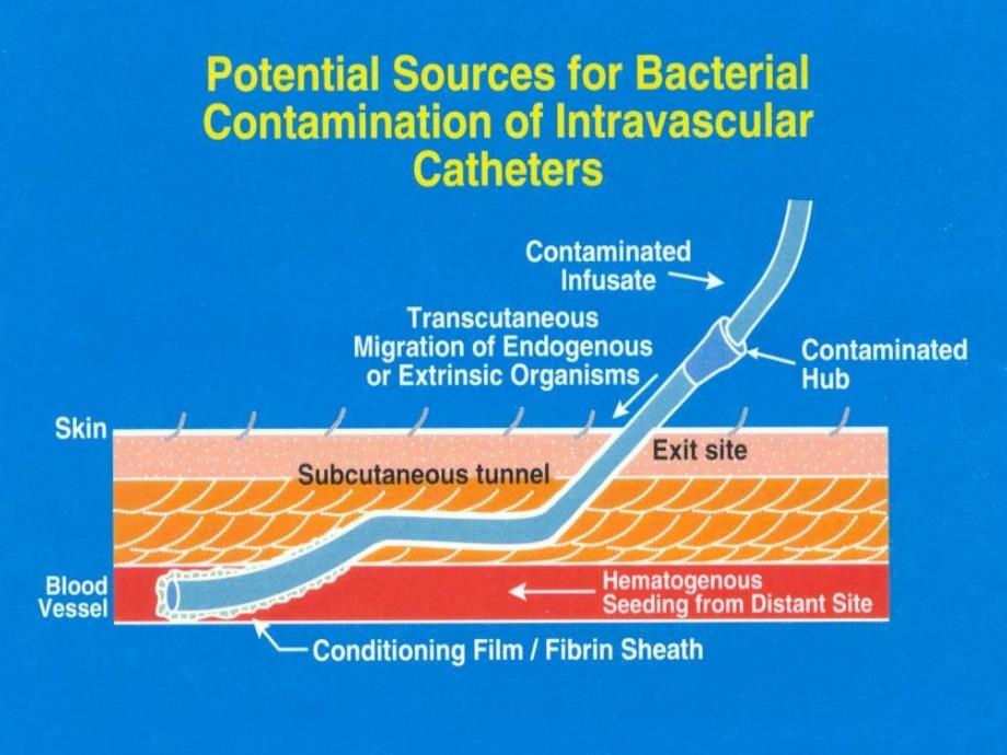 年美国导管相关血流感染预防与控制技术指南的解析课件_第3页