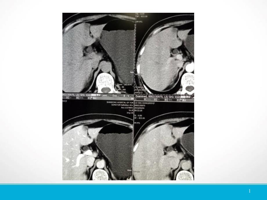 （优质医学）肝脏镰状韧带旁假病灶的CT表现_第1页