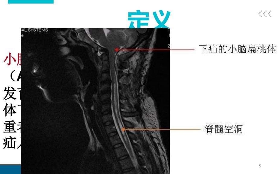 （优质医学）小脑扁桃体下疝畸形_第5页