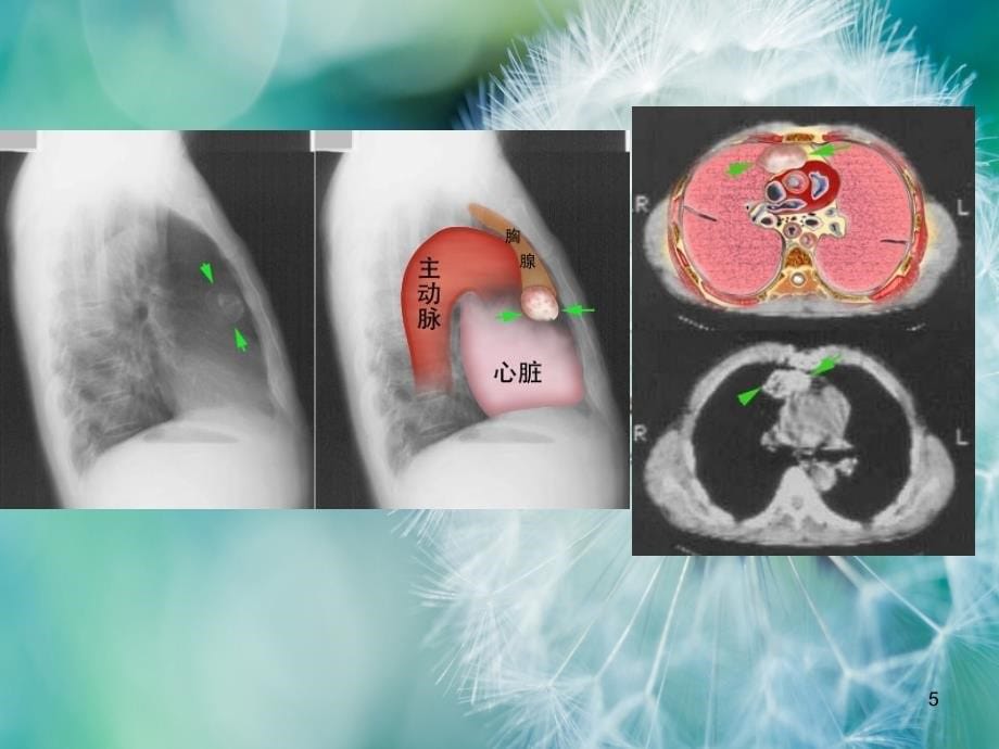 （优质医学）胸腺瘤_第5页