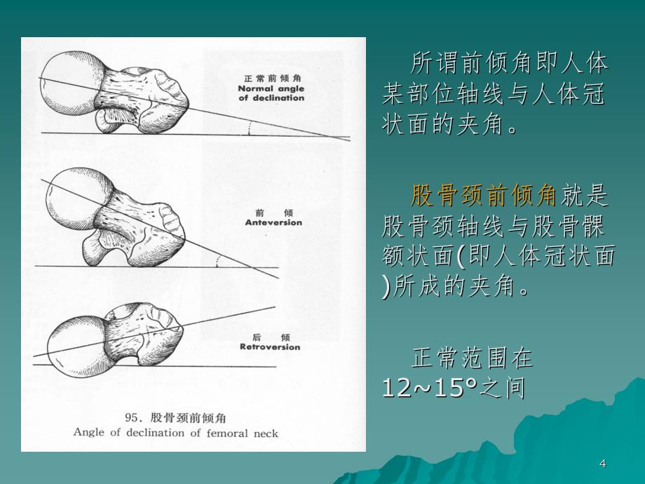 股骨颈前倾角及扭转角区别PPT_第4页