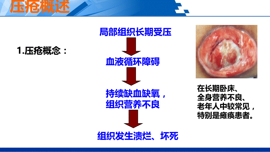 为Ⅰ度压疮老年人提供护理上课件_第3页