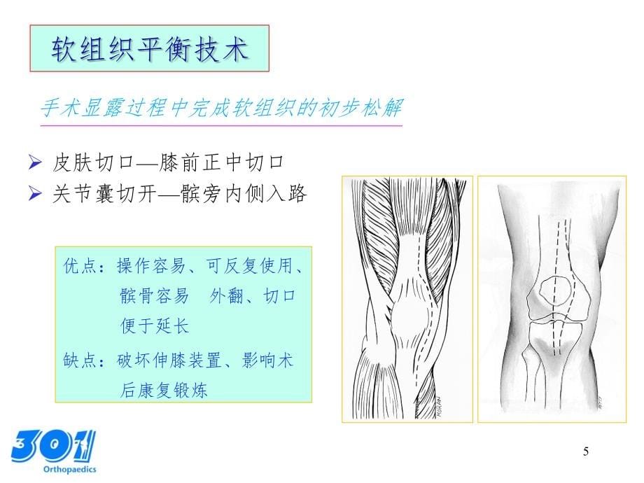 人工膝关节置换的要点分析PPT_第5页