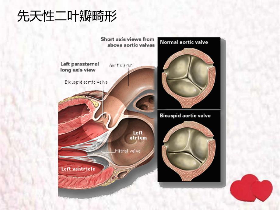 （优质医学）主动脉瓣狭窄_第3页