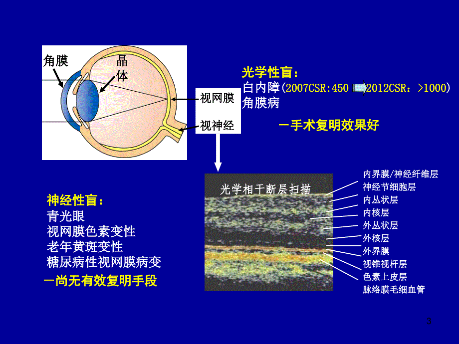 （优质课件）原发性开角型青光眼诊疗规范_第3页