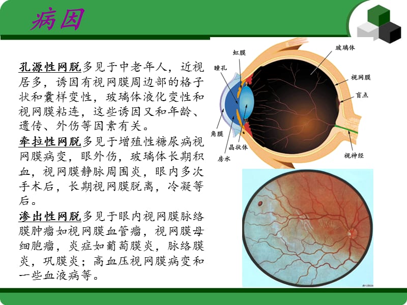（优质课件）视网膜脱落小讲课_第5页