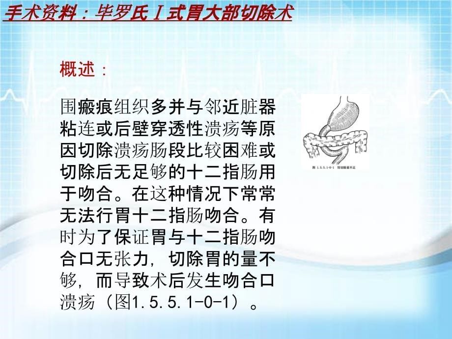 外科手术教学资料：毕罗氏Ⅰ式胃大部切除术讲解模板_第5页