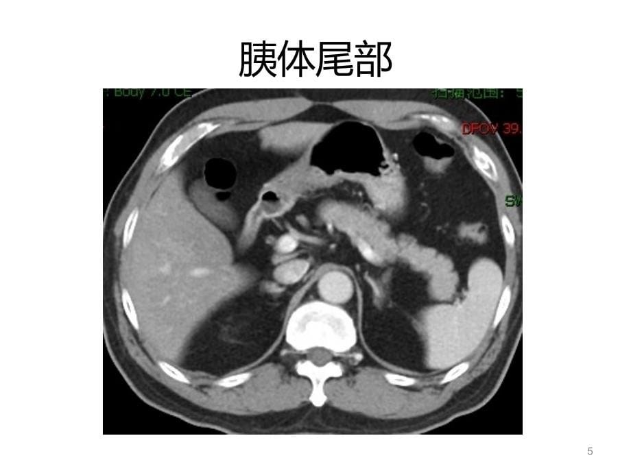 （优质医学）胰腺炎的影像诊断_第5页