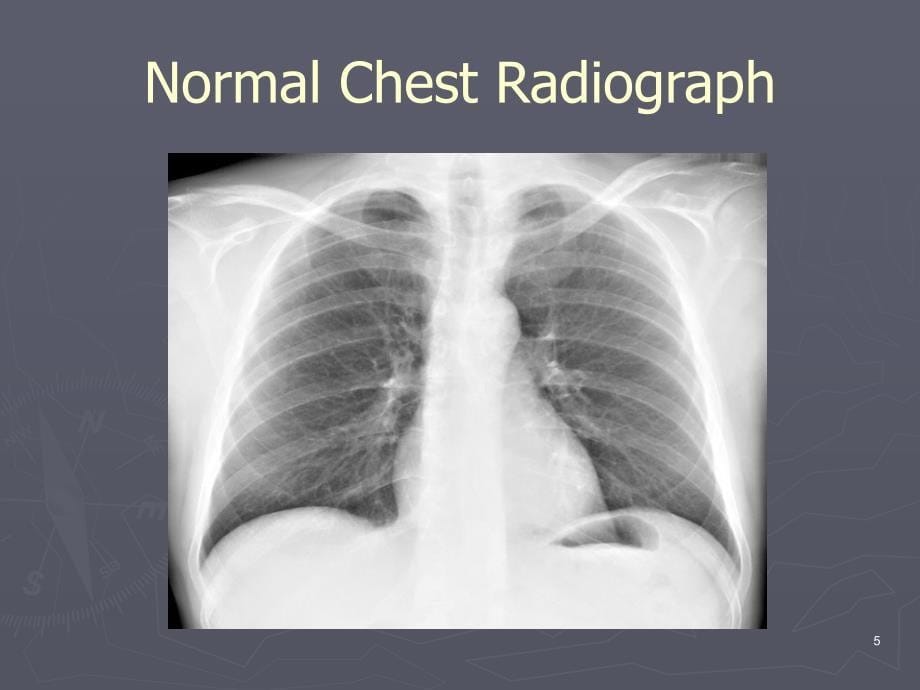 CXR Interpretation胸部医学影像解读（课堂PPT）_第5页