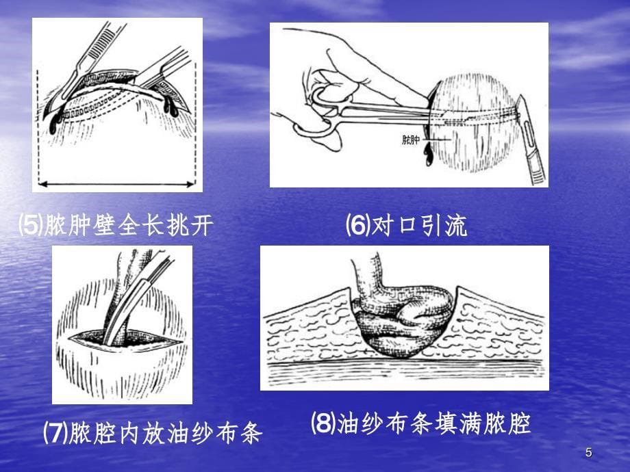 表浅脓肿切开引流术（课堂PPT）_第5页