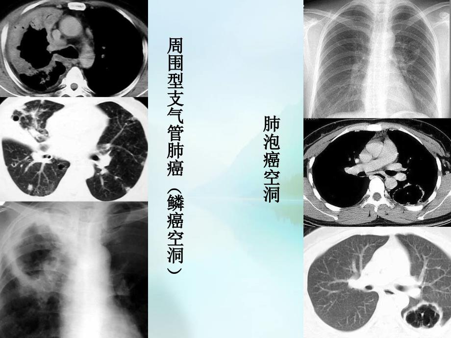 （优质课件）肺部空洞(样)病灶的影像诊断_第4页