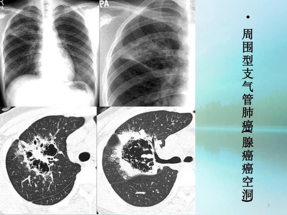 （优质课件）肺部空洞(样)病灶的影像诊断_第5页