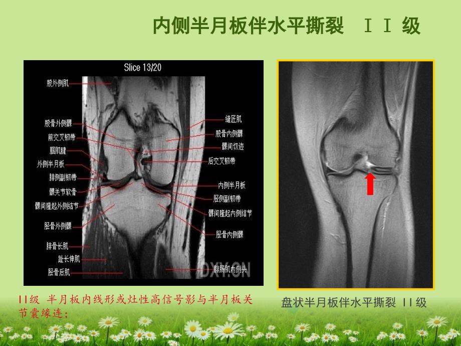 （优质医学）膝关节韧带MRI损伤表现_第3页