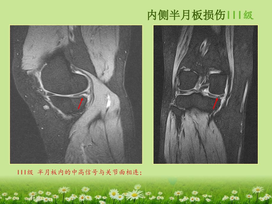 （优质医学）膝关节韧带MRI损伤表现_第4页