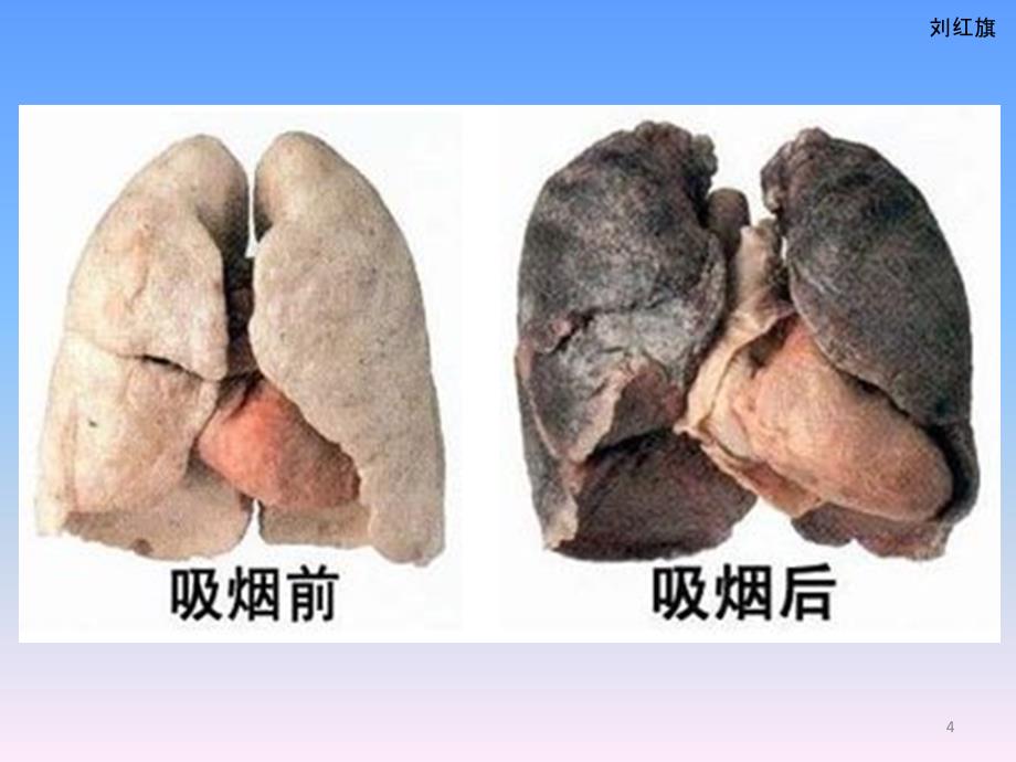 （优质医学）肺部小结节和肺癌_第4页
