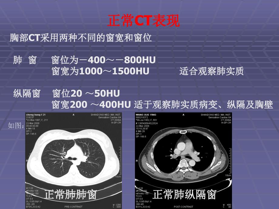 7320编号正常胸肺部CT影像学表现_第2页