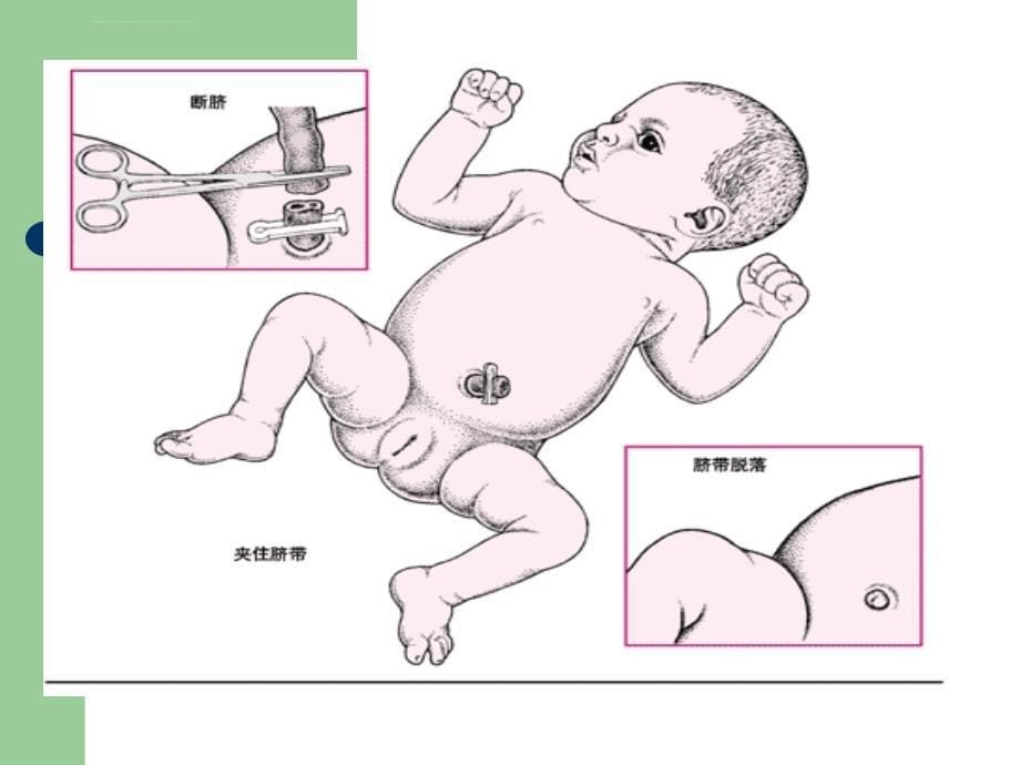 儿科新生儿脐部医疗护理课件_第5页