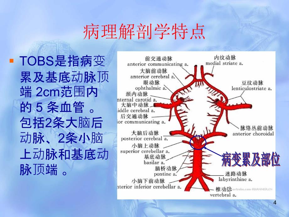 （优质医学）基底动脉尖综合症_第4页