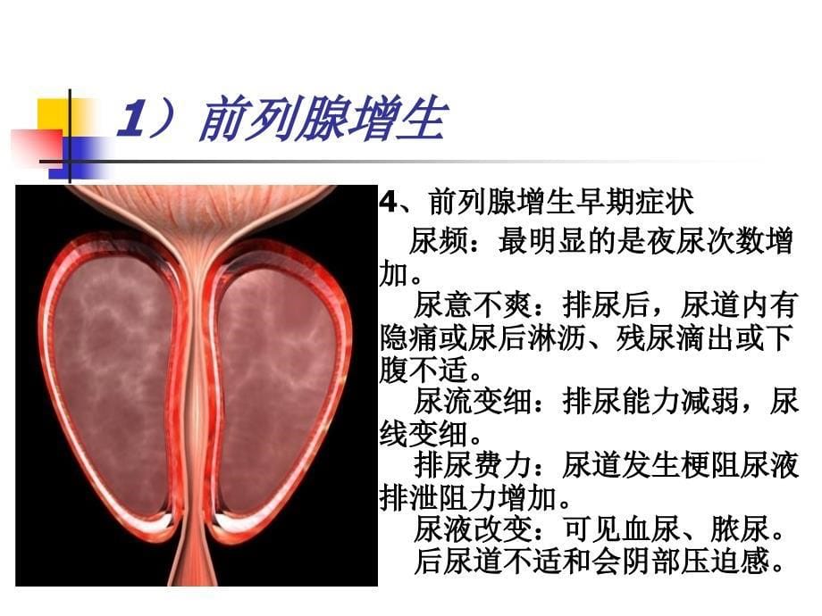 前列腺疾病知识课件_第5页