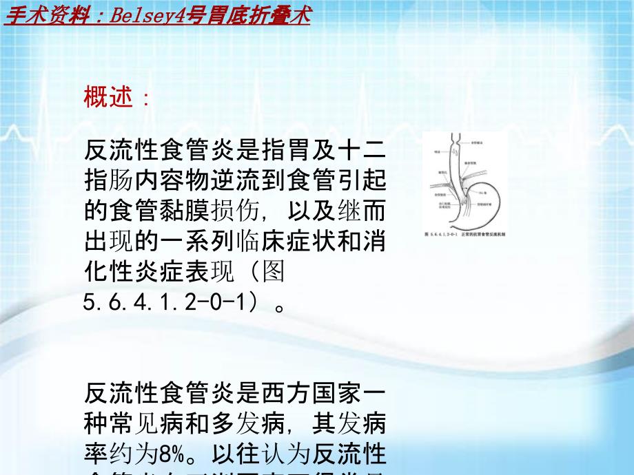 外科手术教学资料：Belsey4号胃底折叠术讲解模板_第4页