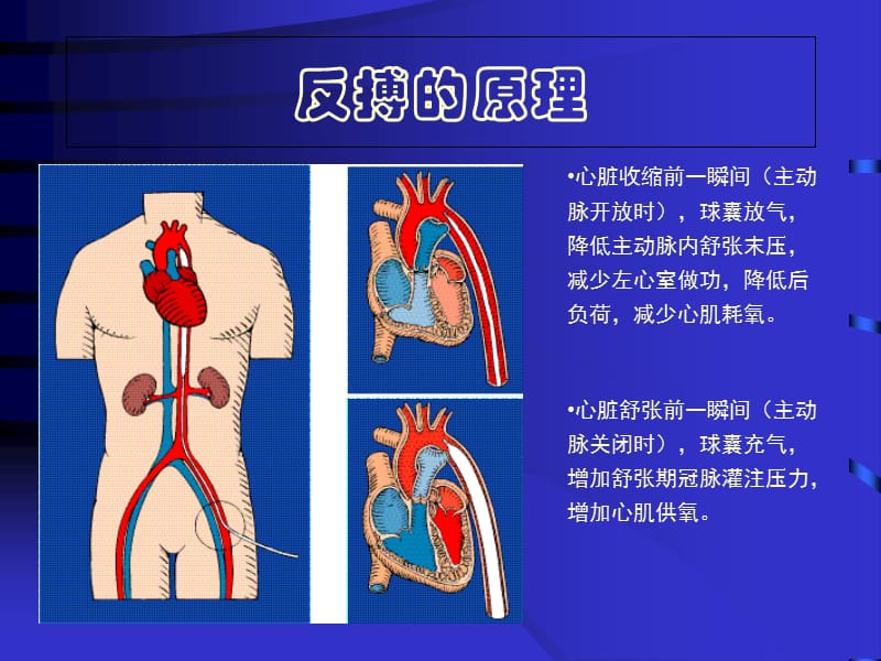 终版IABP教学案例_第3页