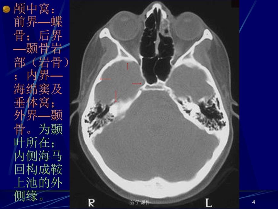 中枢神经系统的ct诊断资料教程_第4页