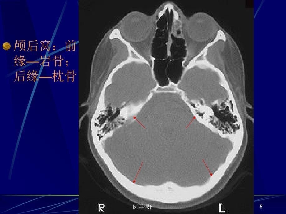 中枢神经系统的ct诊断资料教程_第5页