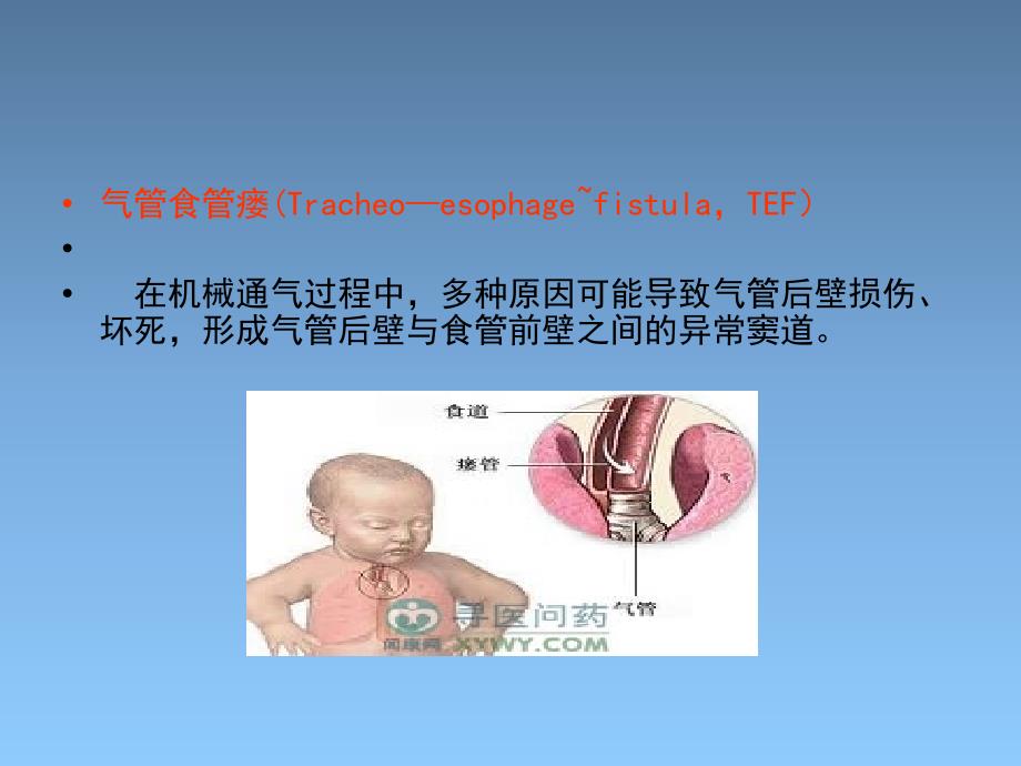 气管食管瘘的原因分析和预防措施PPT_第2页